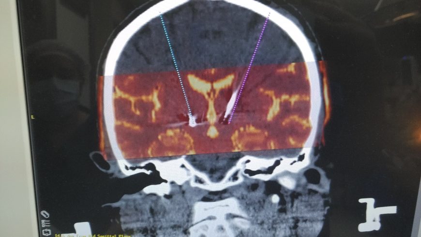 Understanding The Process Of Deep Brain Stimulation (DBS) Surgery ...